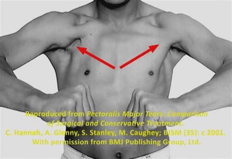 pec tear warning signs